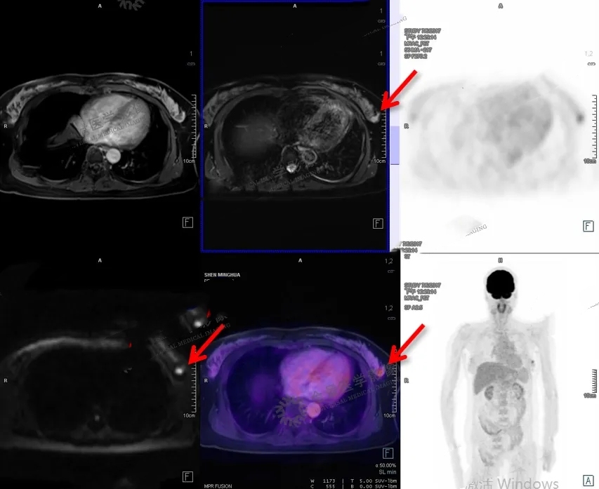 全身深度健检（PET-MR版）